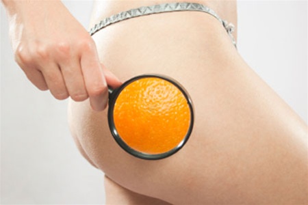 Антицеллюлитная диета: как избавиться от «апельсиновой корки» раз и навсегда